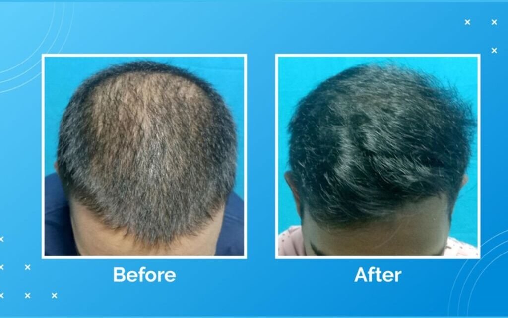 Vcare’s Treatment For Hair Loss And Hair Thinning